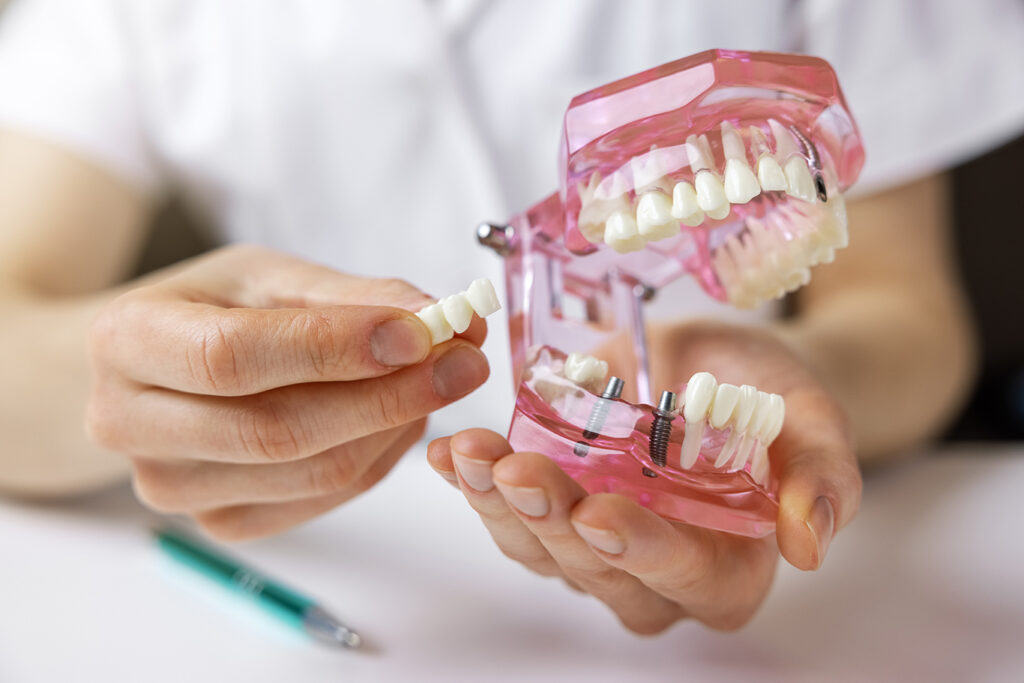 A close-up of a person holding a dental model with visible dental implants in the lower jaw, while positioning a dental bridge.