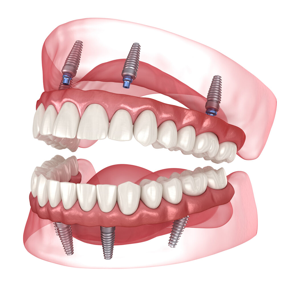 Illustration with an example of an All-on-4