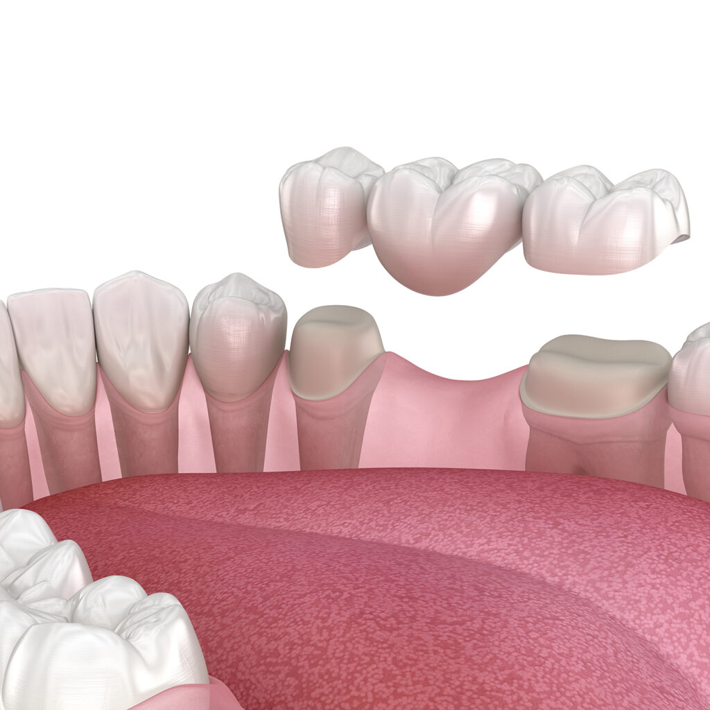 Illustration with an example of an implant-supported bridge