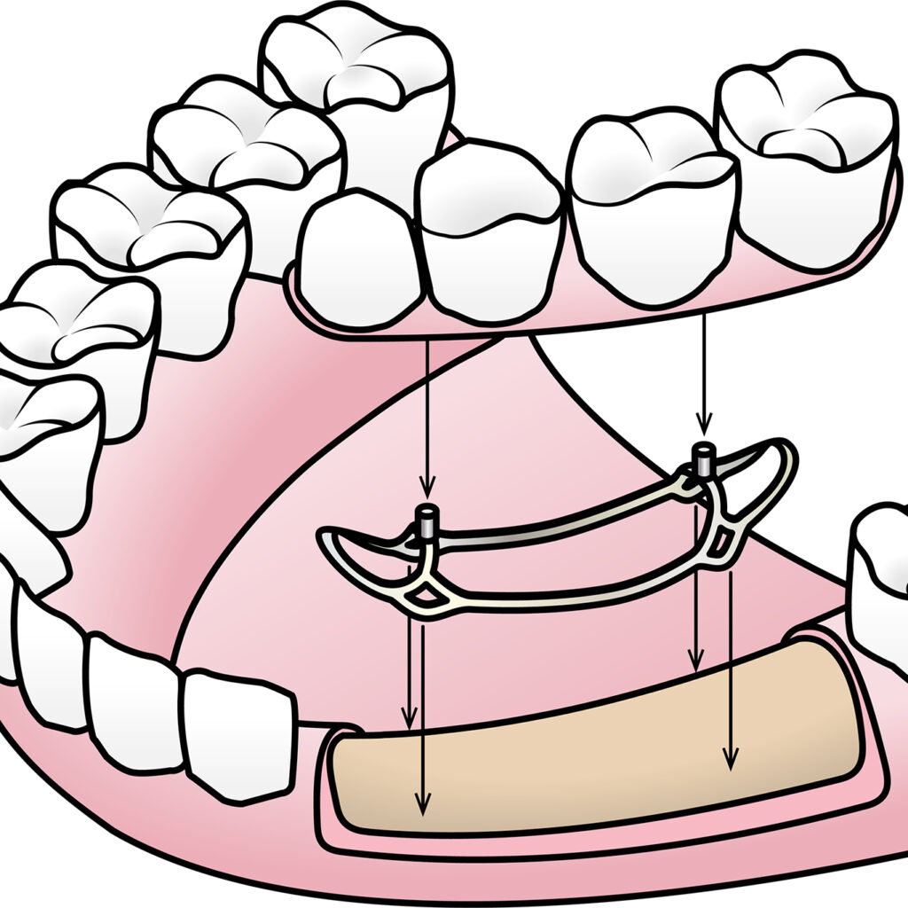Illustration with an example of a subperiosteal implant