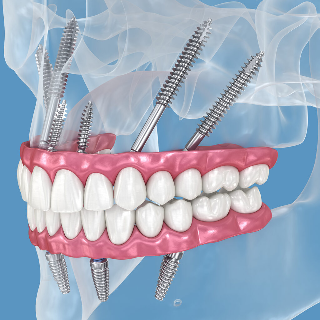 Illustration with an example of a zygomatic implant