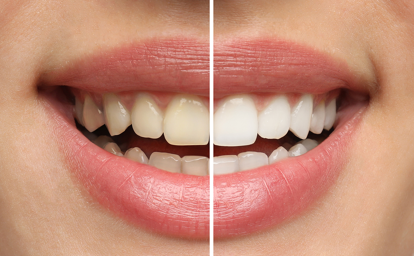 Close-up of a smiling mouth showing a before-and-after comparison of teeth whitening.