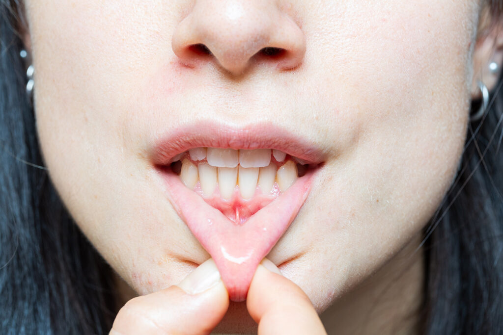 Close up of a girl's mouth showing her teeth and her receding gums