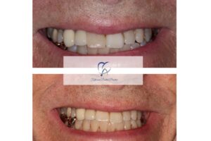 Dental implant before and after, smile close-up