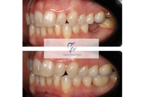 Dental implant, molar, before and after, mouth close-up
