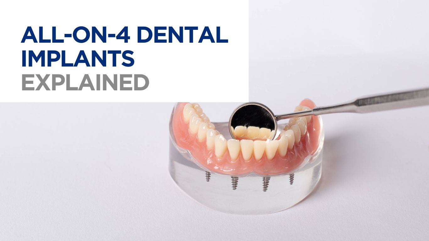 An All-on-4 dental typodont with a dental mirror.