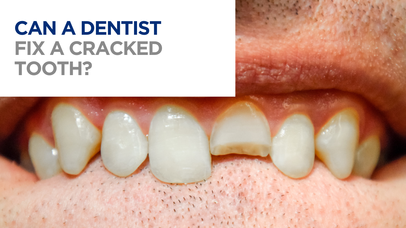 Cracked tooth, close up of a mouth